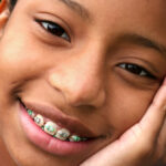Bonded Brackets - Traditional Braces in Mt Vernon & Orcas Island WA - Halgren Orthodontics