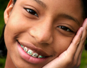 Bonded Brackets - Traditional Braces in Mt Vernon & Orcas Island WA - Halgren Orthodontics