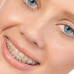 Clear or Ceramic Braces in Mt Vernon & Orcas Island WA - Halgren Orthodontics