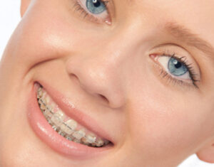 Clear or Ceramic Braces in Mt Vernon & Orcas Island WA - Halgren Orthodontics